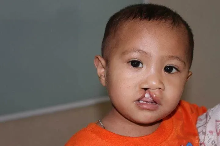 Đăng ký ngay mổ sứt môi hở hàm ếch hoàn toàn miễn phí image-1732293014259